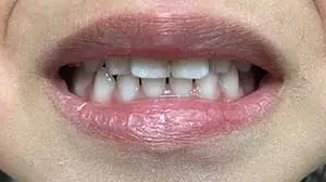 Crossbite Correction Kenosha | Denthetics LLC Kenosha WI After 1