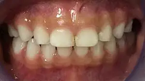 Crossbite Correction Kenosha | Denthetics LLC Kenosha WI After 2