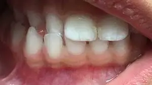 Crossbite Correction Kenosha | Denthetics LLC Kenosha WI Before 1