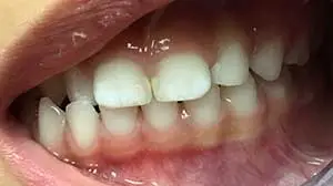 Crossbite Correction Kenosha | Denthetics LLC Kenosha WI Before 2